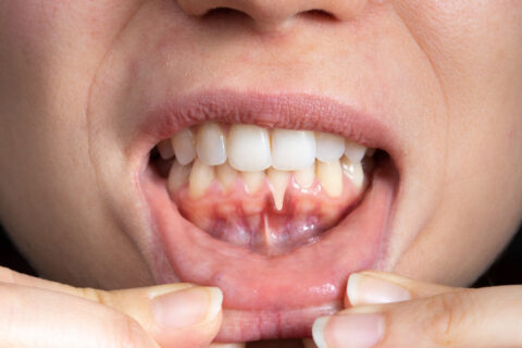 Close-up of a person pulling down their lower lip to show receding gums and dark pigmentation on the inner gum.
