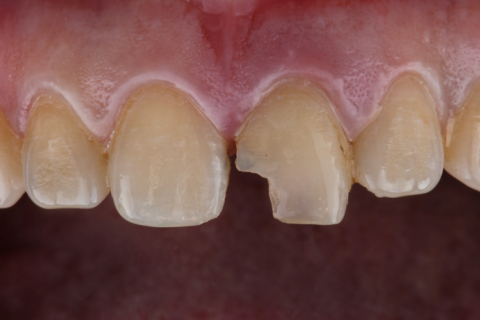Close-up of a chipped tooth on upper front teeth, showing dental damage.