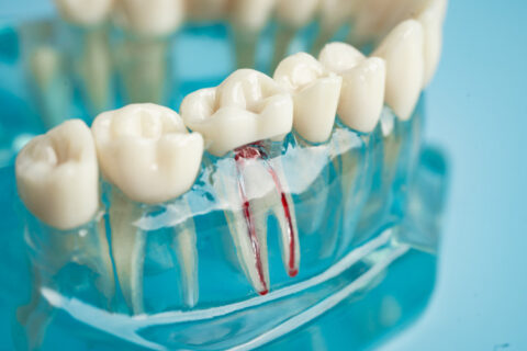 root canal myths