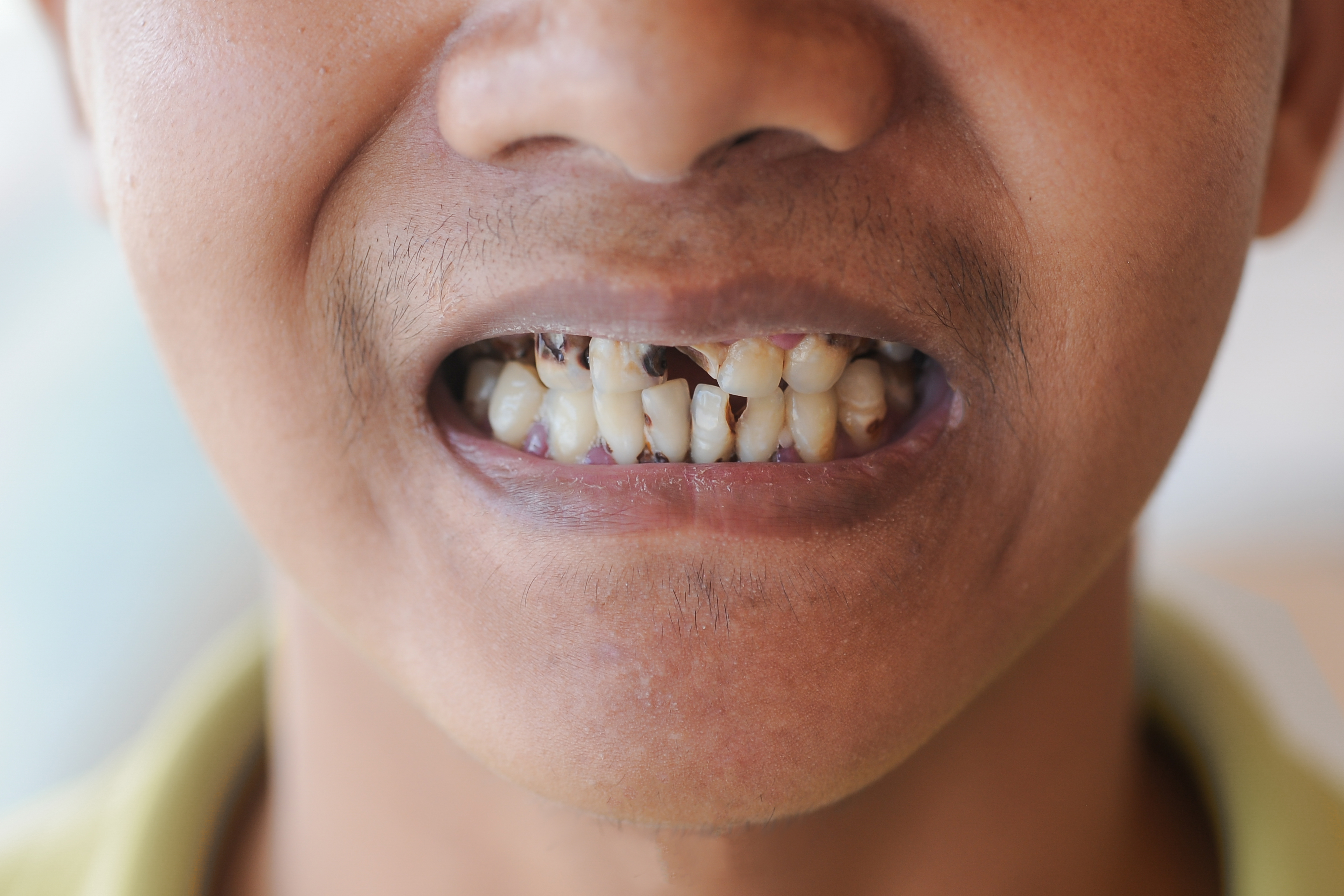 how to fix a broken tooth